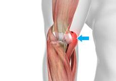 Golfer’s Elbow